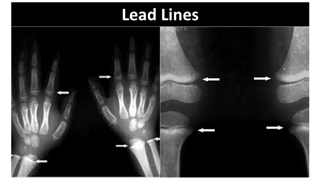 Lead Poisoning- Lead Lines