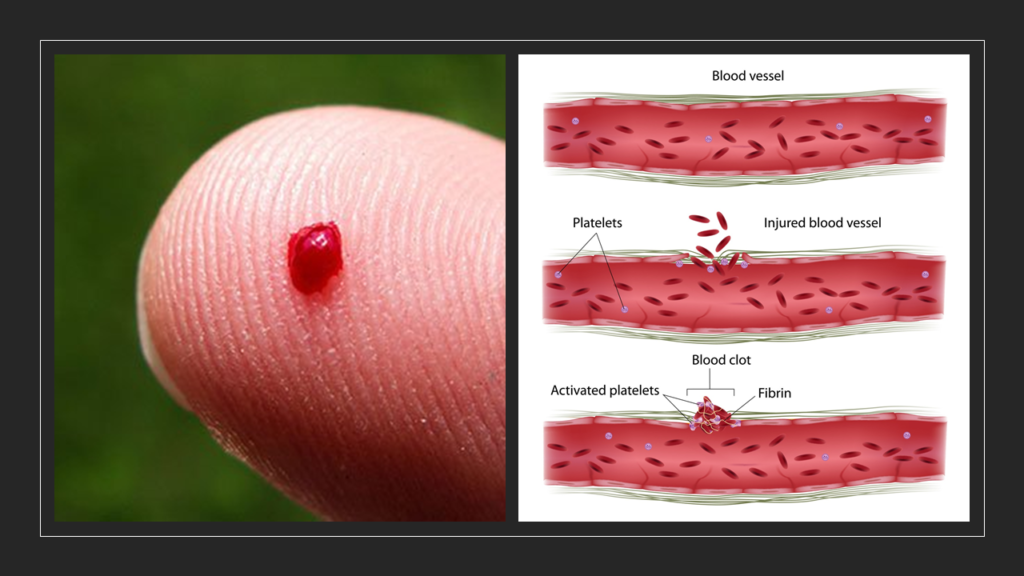 von Willebrand’s Disease clotting