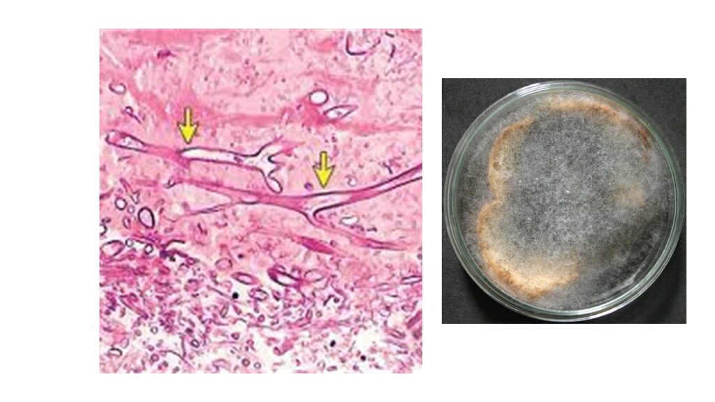 Mucormycosis and Covid biopsy culture