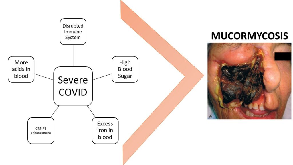 Mucormycosis and Covid link