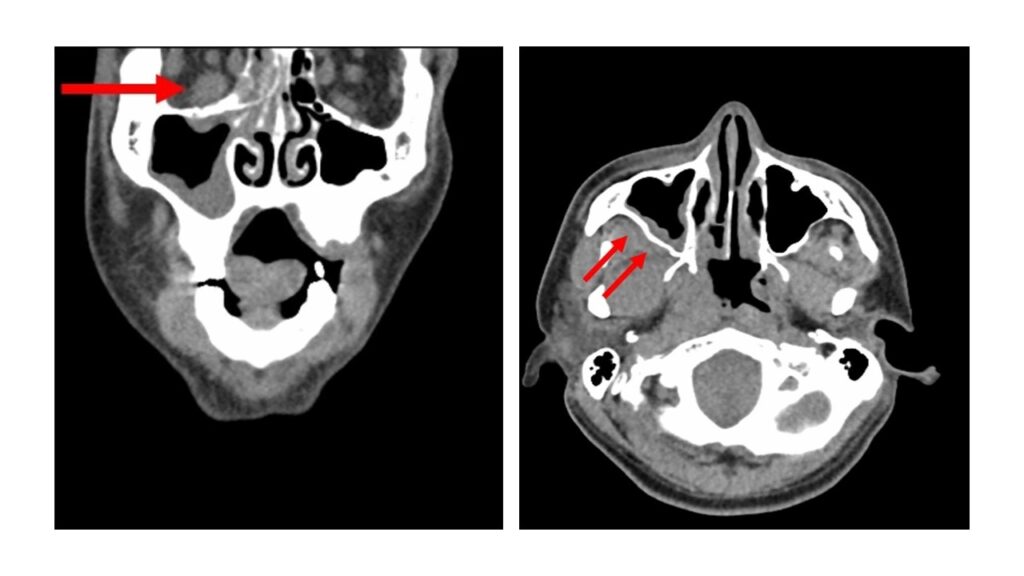 Mucormycosis and Covid radiology