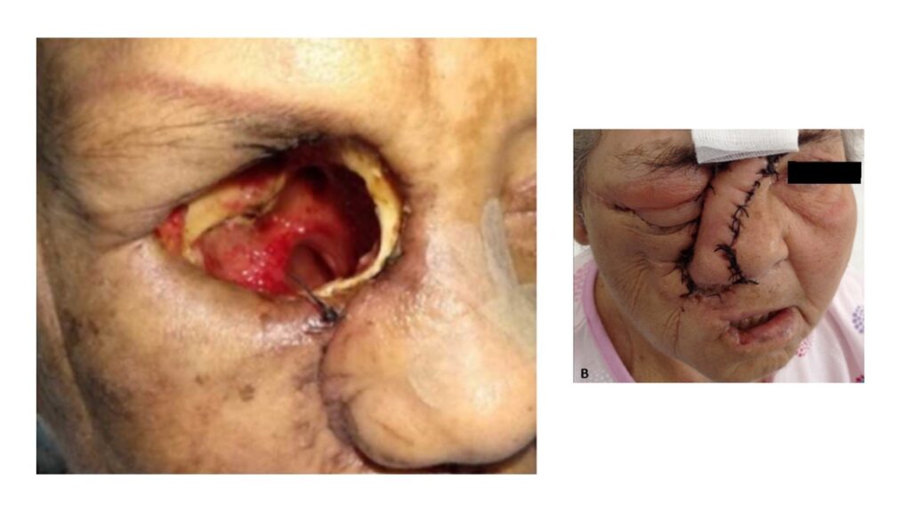 Mucormycosis and Covid surgery