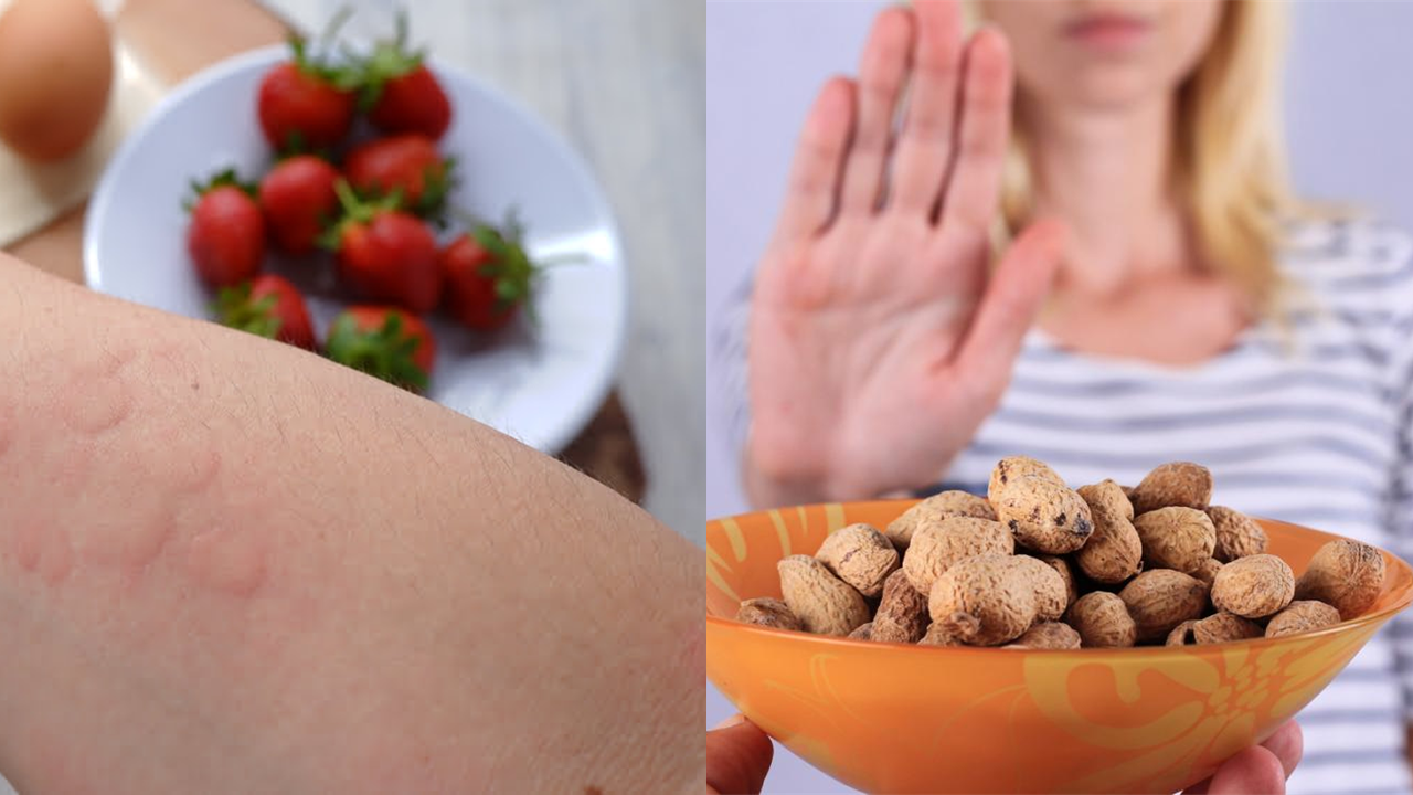 Decoding The Mystery Of Rising Food Allergies Globally