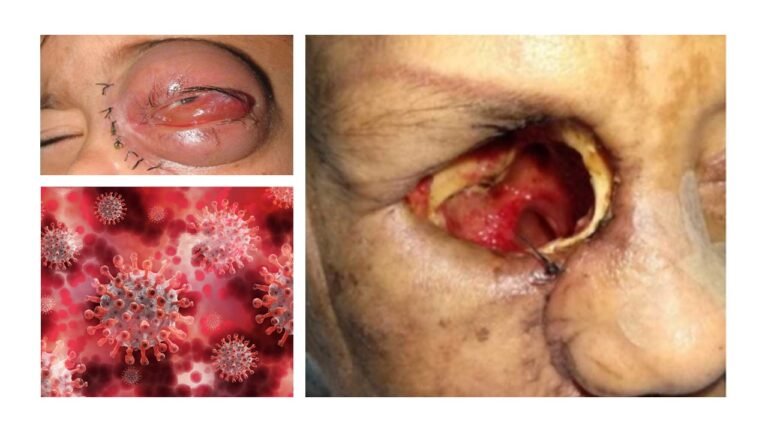 Mucormycosis and Covid