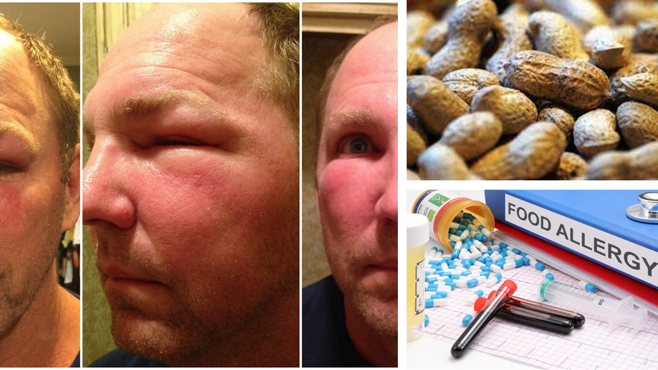 Food allergies