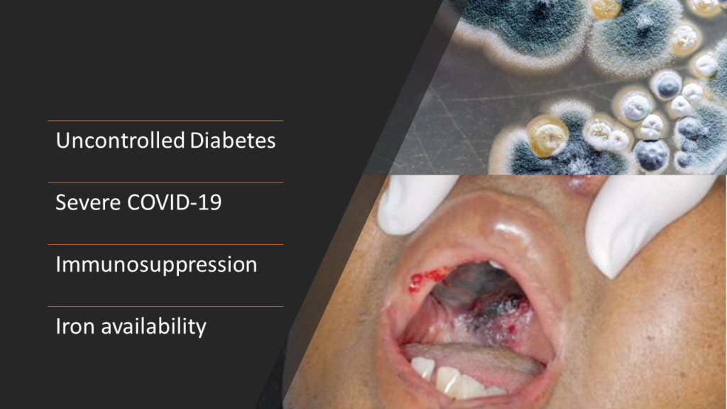 Defeating COVID-19- cause of mucormycosis