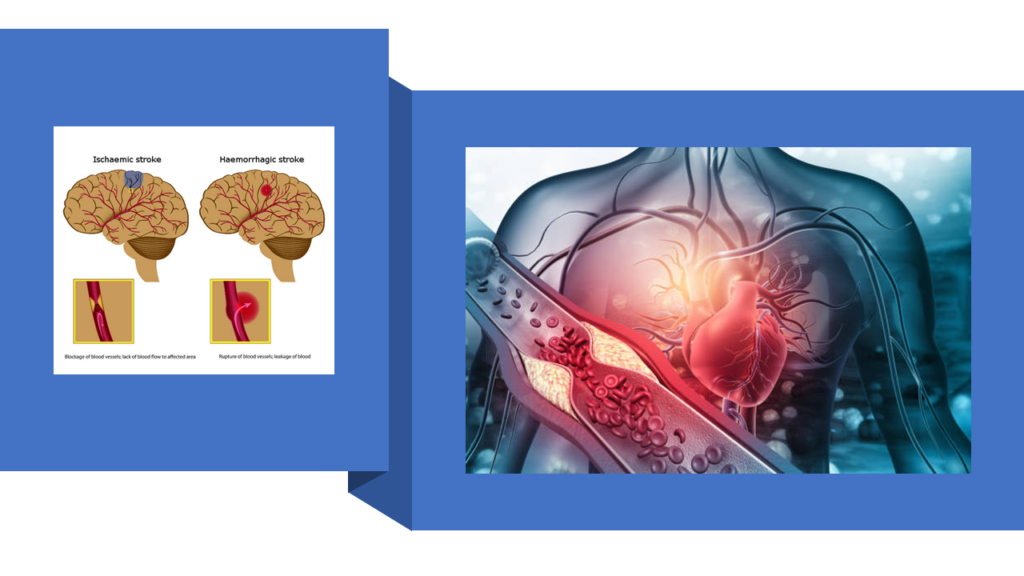 Genesis of Heart Attacks and Strokes